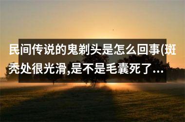 <h3>民间传说的鬼剃头是怎么回事(斑秃处很光滑,是不是毛囊死了)