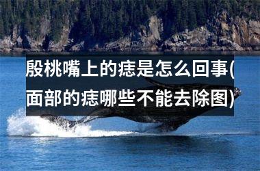 <h3>殷桃嘴上的痣是怎么回事(面部的痣哪些不能去除图)