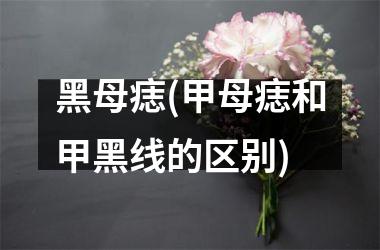 <h3>黑母痣(甲母痣和甲黑线的区别)