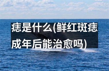 <h3>痣是什么(鲜红斑痣成年后能治愈吗)