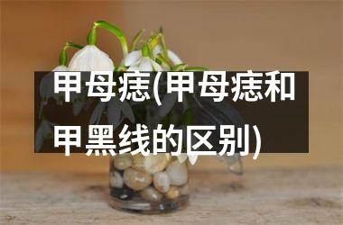 甲母痣(甲母痣和甲黑线的区别)