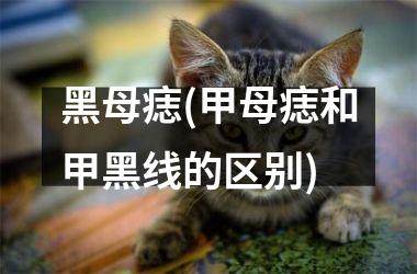 黑母痣(甲母痣和甲黑线的区别)